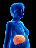 Illustration of an obese woman's liver