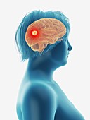 Illustration of a tumour in a woman's brain