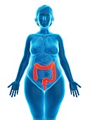 Illustration of an obese woman's colon