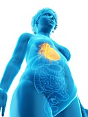 Illustration of an obese woman's heart