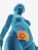 Illustration of a tumour in a woman's small intestine