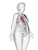 Illustration of an obese woman's heart