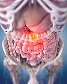 Illustration of a colon tumour