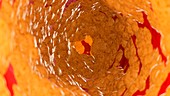 Illustration of fat inside of an artery