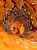 Illustration of a stent inside of a fatty artery