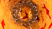 Illustration of a stent inside of a fatty artery