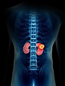 Illustration of a man's kidney tumour