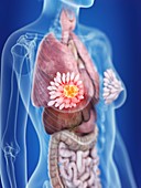 Illustration of a woman's mammary glands cancer