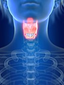 Illustration of an inflamed larynx