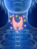 Illustration of autoimmune thyroid disease