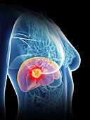 Illustration of a woman's liver cancer