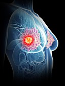 Illustration of a woman's mammary glands cancer