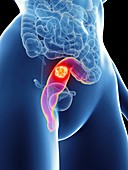 Illustration of a woman's rectum cancer