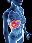 Illustration of a woman's liver cancer