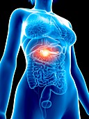 Illustration of a woman's painful pancreas