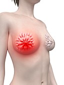 Illustration of inflamed mammary glands