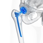 Illustration of a hip replacement