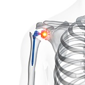 Illustration of a shoulder replacement