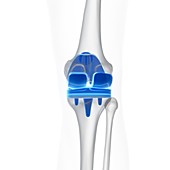 Illustration of a knee replacement