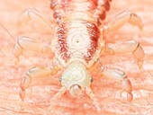 Illustration of a head louse on human skin