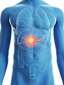Illustration of a man's pancreas cancer