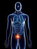 Illustration of a man's bladder cancer