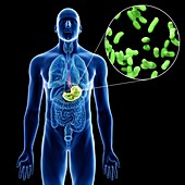 Illustration of a man's stomach infection