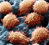 Hairy Cell Leukaemia, SEM