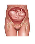 Foetus in Shoulder Position, Illustration