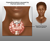 Hyperthyroidism, Illustration
