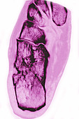 Osteoarthritis in Foot, X-ray