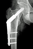 Hip with Nail-plate, Osteosynthesis, X-ray