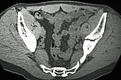 Fracture of Left Pelvis