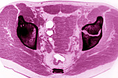 Fracture of Left Pelvis