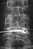 Steroid Injection into Spine, X-ray