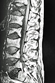 Osteoporosis on Lumbar Vertebrae, MRI