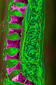 Osteoporosis on Lumbar Vertebrae, MRI