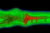 Osteosynthesis of Wrist