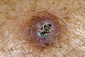 Squamous Cell Carcinoma on Leg