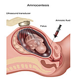 Amniocentesis, Illustration