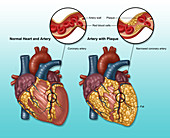 Heart and Artery, Normal vs. Hardened
