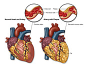 Heart and Artery, Normal vs. Hardened