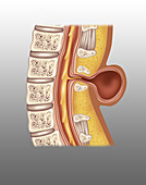 Spina Meningocele, Illustration