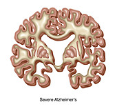 Severe Alzheimer's, Illustration