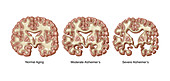 Alzheimer's Brain Deterioration, Illustration