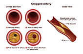 Catheter for Atherosclerosis, Illustration