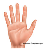 Ganglion Cyst, Illustration