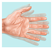 Hand Tremors, Illustration