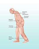 Parkinson's Symptoms, Illustration