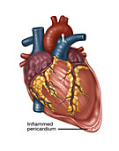 Heart with Pericarditis, Illustration